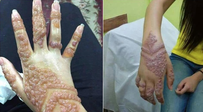 Photo of Chinese Mehendi that causes serious health hazards Goes Viral