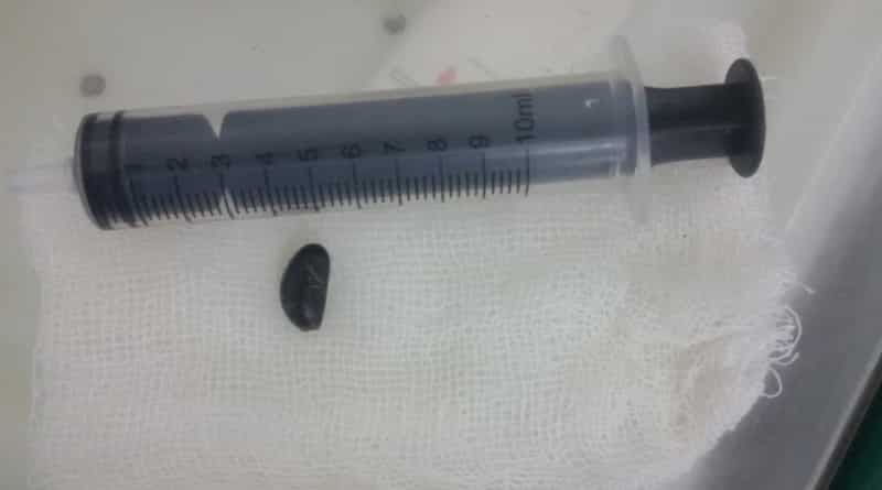 Doctors successfully performs complex surgery on child