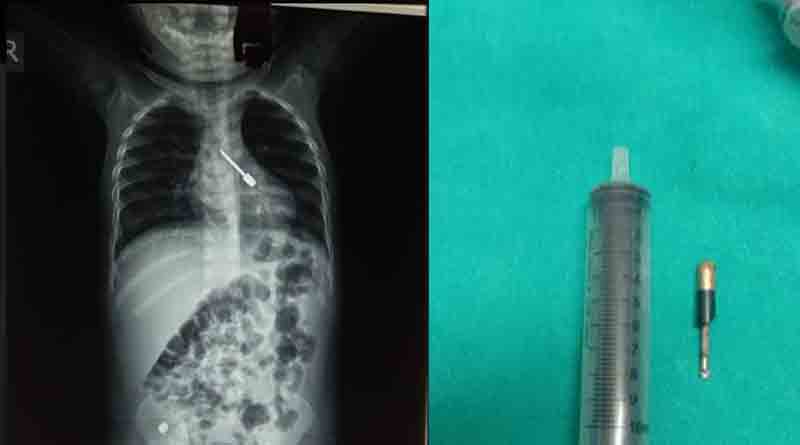 13th months old child is out of danger in Burdwan hospital