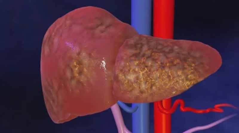 daughter donates liver to mother