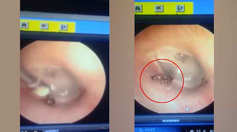 Watch: ant removed from a man's ear