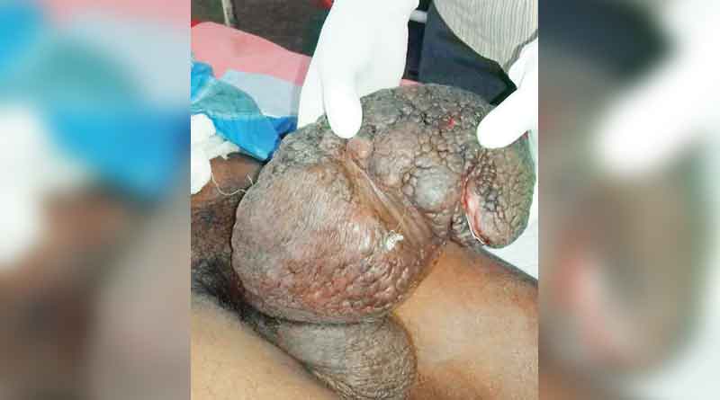 Bandit king operated on in Kolkata 