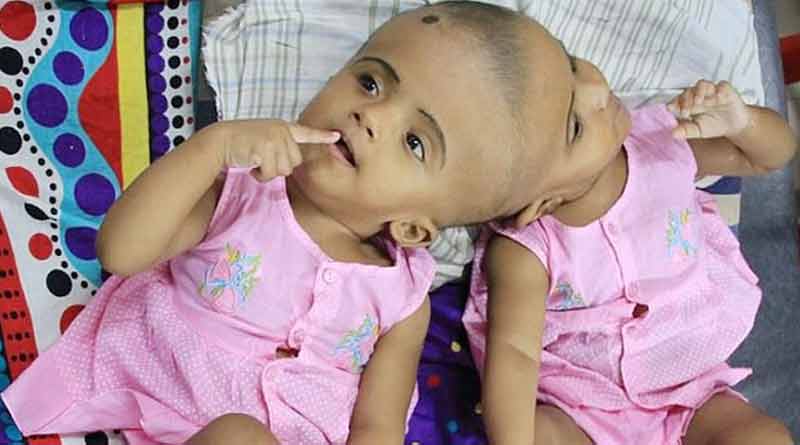 Hope for Bangladesh Conjoined twins 