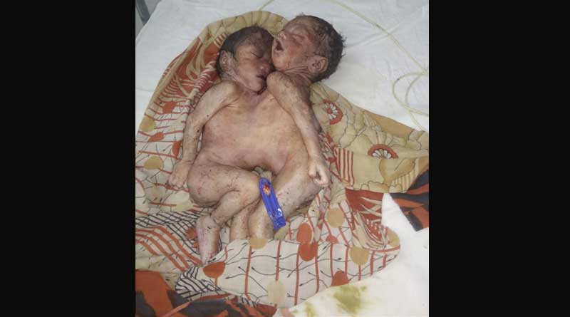 Conjoined babies born at Katwa in East Burdwan