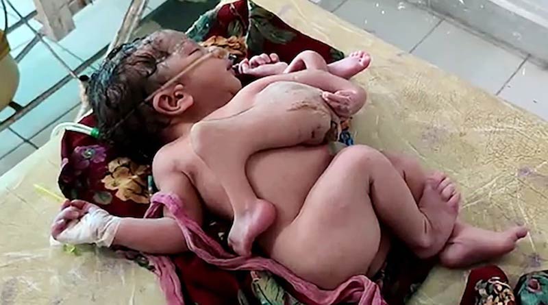 baby was born with four legs and three hands in Rajasthan