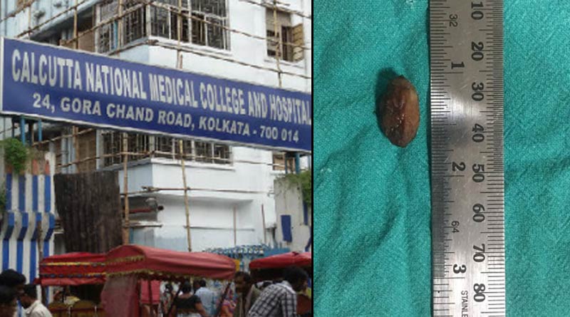Doctor's of Kolkata Medical college successfully performs a rare surgery
