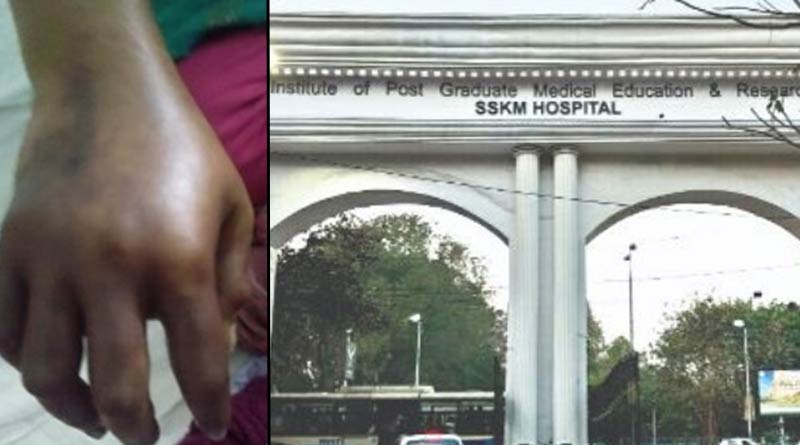 A woman lost her right hand due to wrong treatment