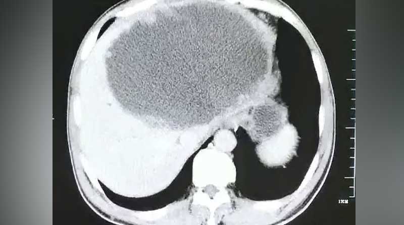 Chinese man loses half his liver to flesh-eating parasites