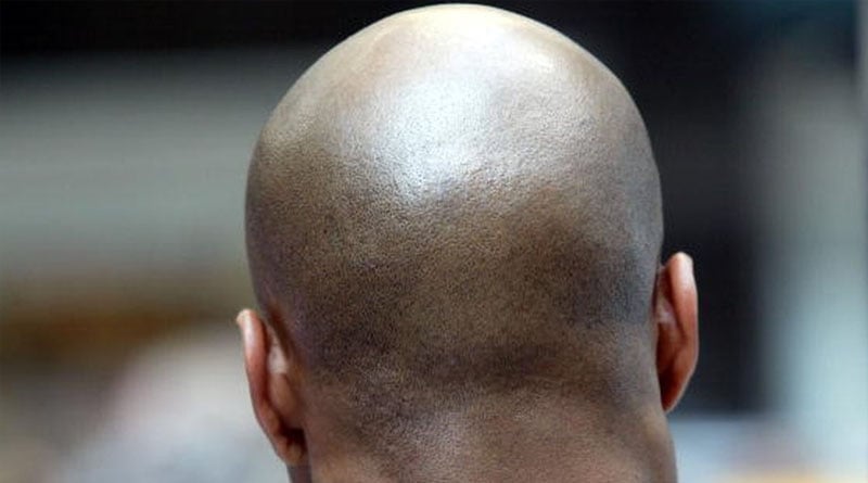 Calling someone bald at work is sexual harassment, rules employment tribunal has | Sangbad Pratidin
