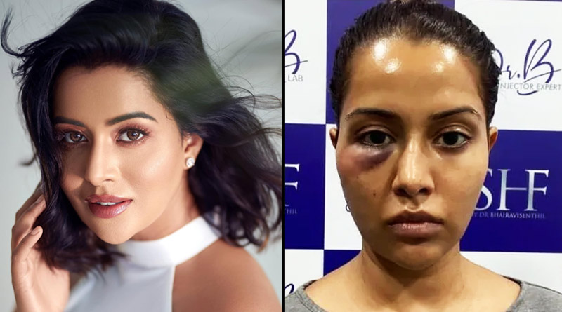 Tamil actress Raiza Wilson says she was ‘forced’ to undergo dermatological treatment, shares her photo after it goes wrong | Sangbad Pratidin