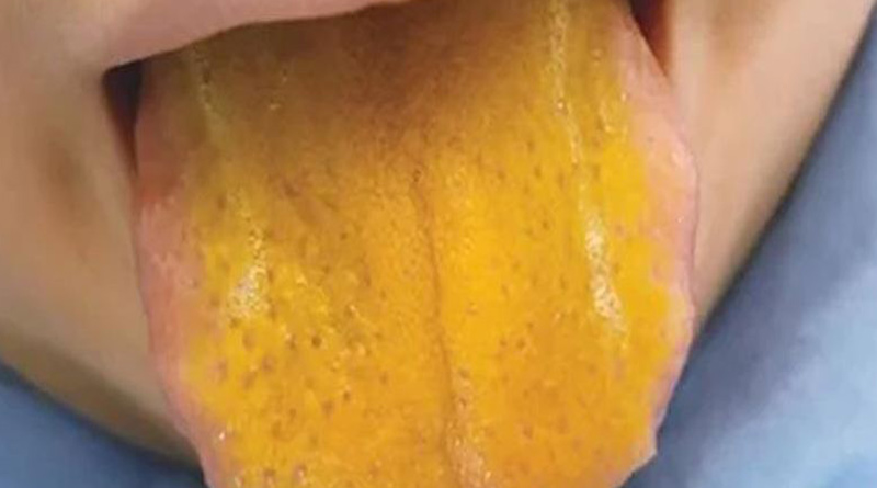 Boy with bright yellow tongue diagnosed with rare disorder in Canada | Sangbad Pratidin