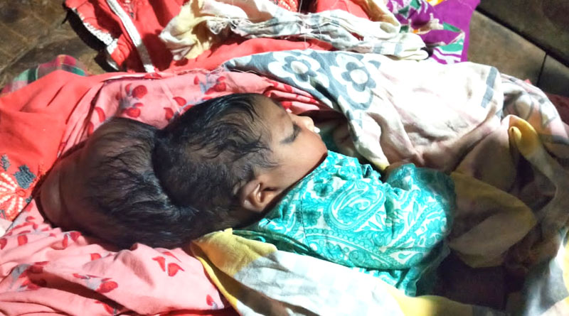 Baby born with two head, one body Murshidabad | Sangbad Pratidin