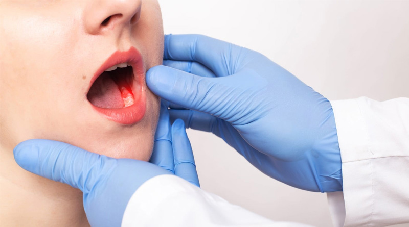 Signs and symptoms of mouth cancer
