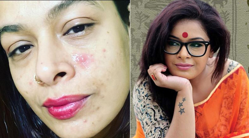 Iman Chakraborty suffering from critical skin diseases | Sangbad Pratidin
