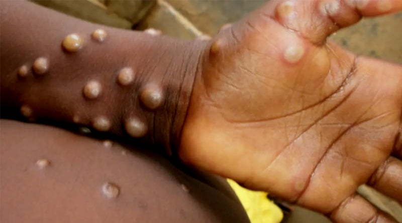 21-day isolation, keeping lesions fully covered: Centre's guidelines for monkeypox | Sangbad Pratidin