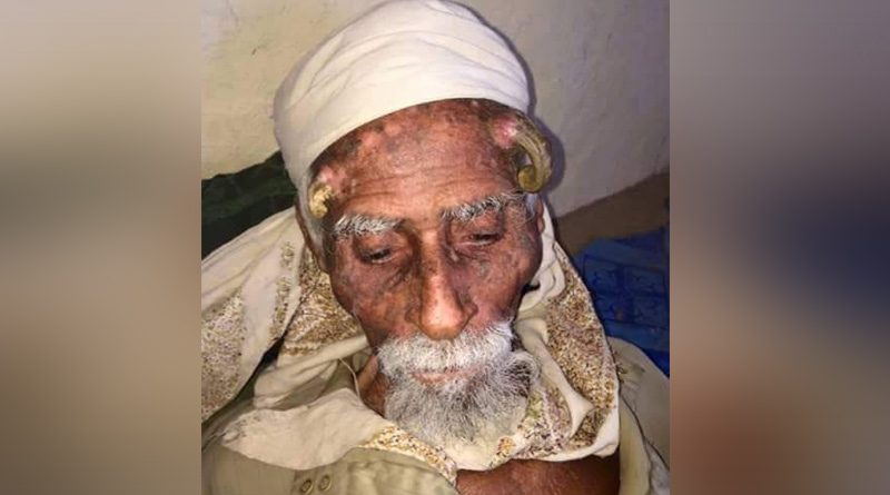 Man with two horn-like growths on his head dies। Sangbad Pratidin