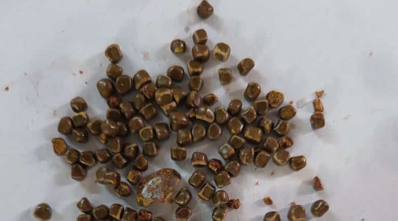 200 stones taken out from gallbladder of woman from Hind Motor | Sangbad Pratidin