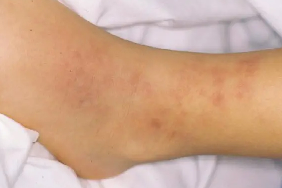 Vasculitis-1