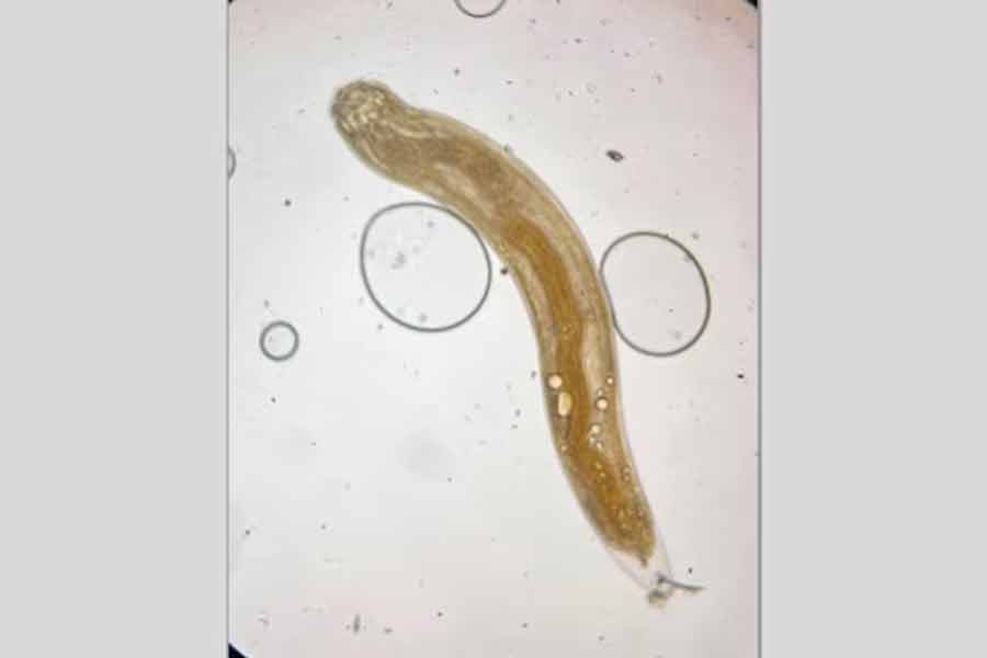 Live worm in the eye of a man of Madhya Pradesh