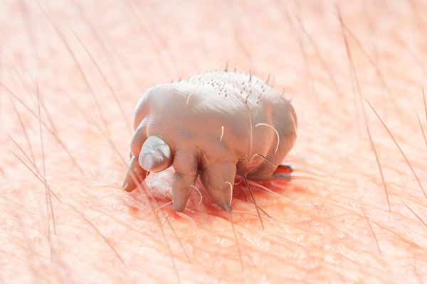 symptoms of Scabies 