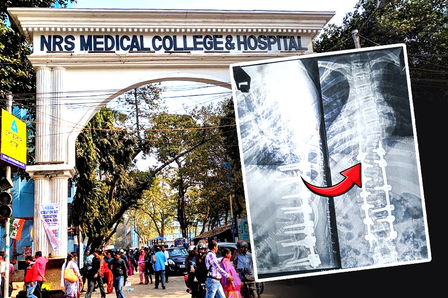 Successful complex spine surgery at NRS Hospital