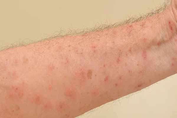 treatment for Scabies