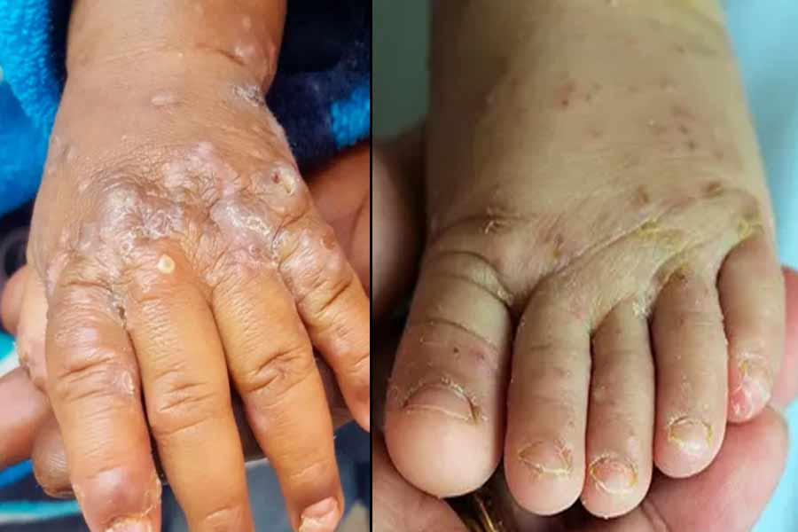 Here are some important information over scabies