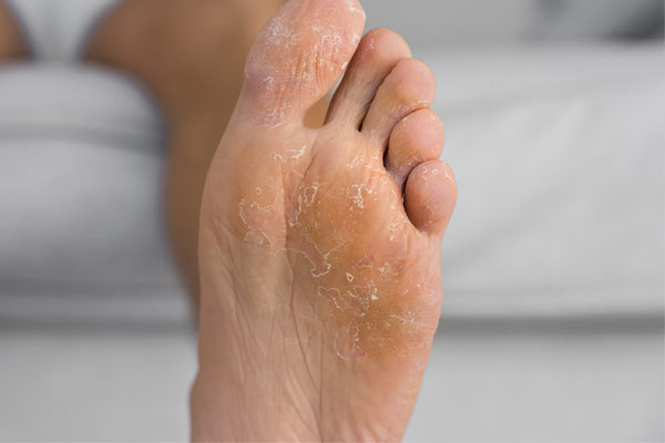 Athlete’s Foot