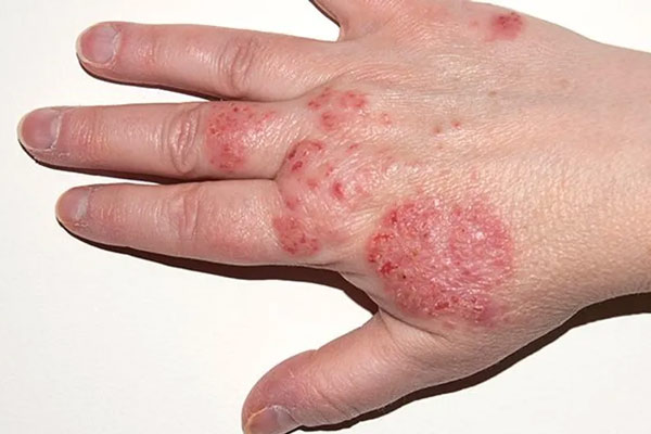 Eczema