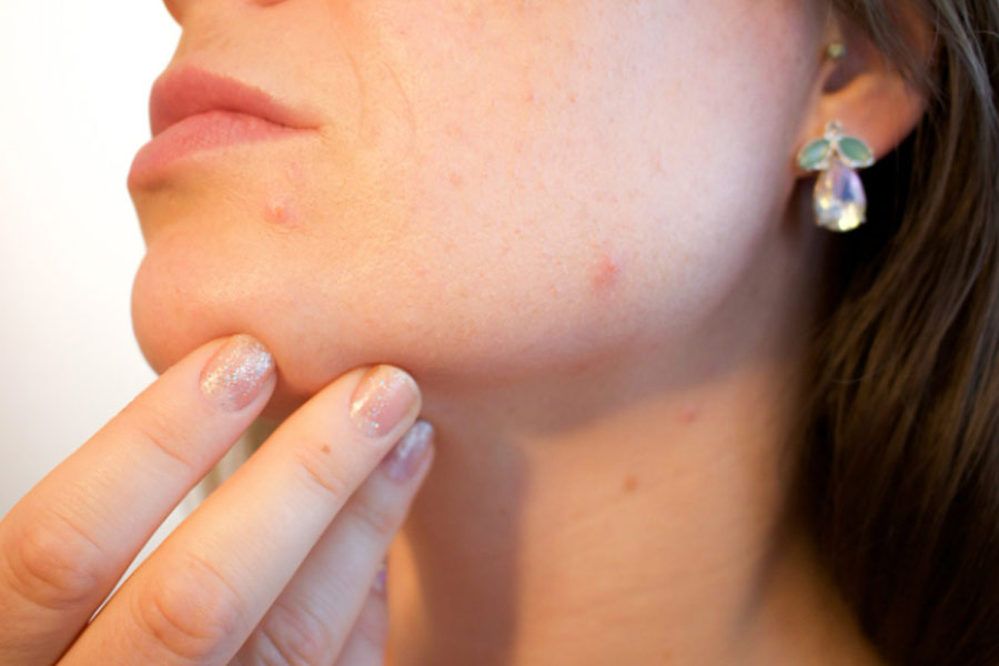 Here are some preventive tips of fungal infections