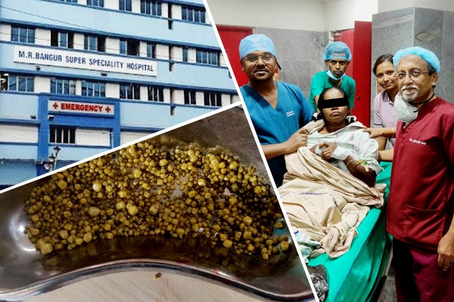 M R Bangur Hospital: Surgeons removed nearly a thousand stones from gallbladder
