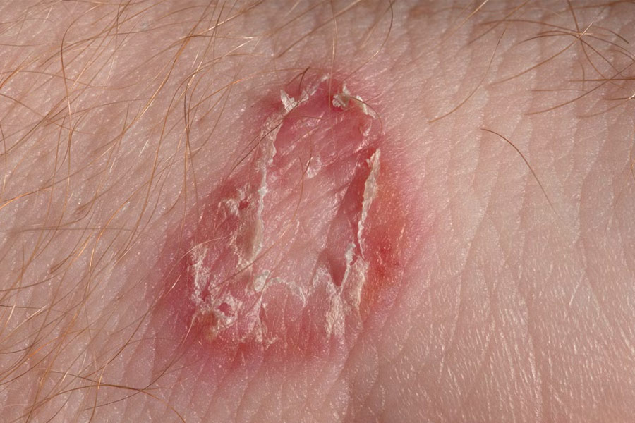 Ringworm