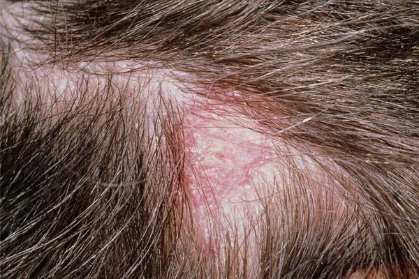 Scalp Ringworm 