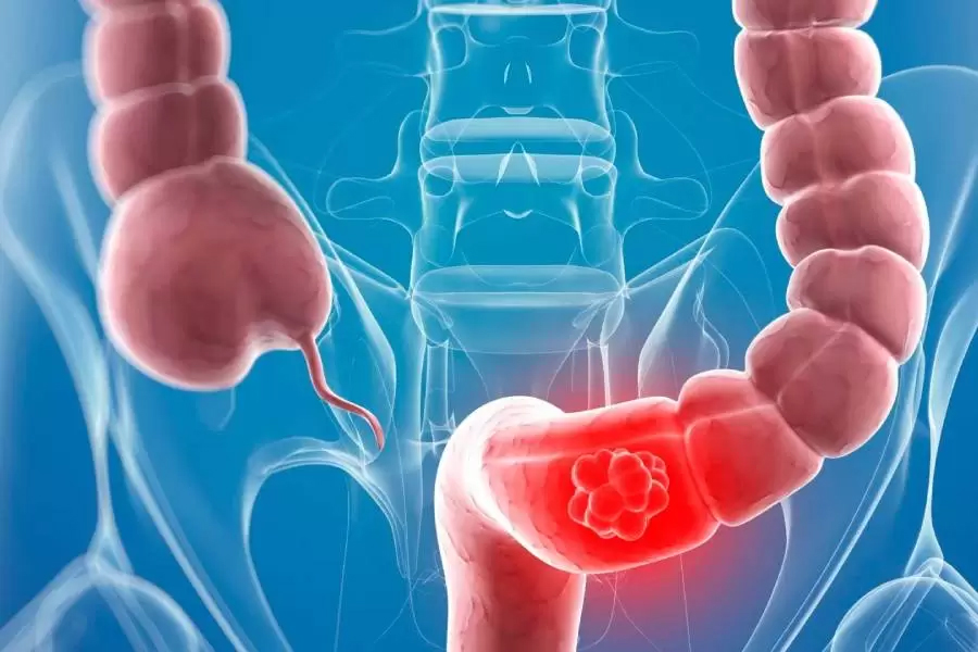 Colon cancer is increasing among young people, doc warn of 5 signs