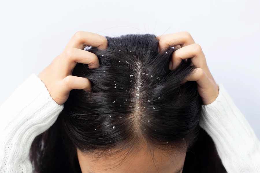 Dandruff