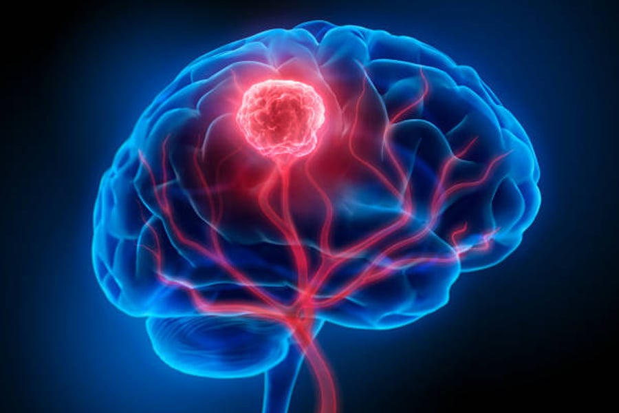 Air pollution is now linked to Brain Tumour, research shows