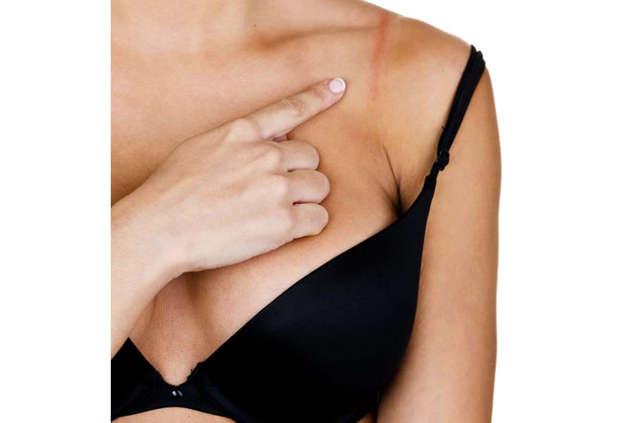 Does wearing a tight bra increase the risk of breast cancer 
