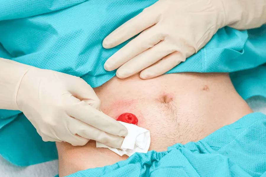 Prescription Plus: Expert Guide to Hernia Care