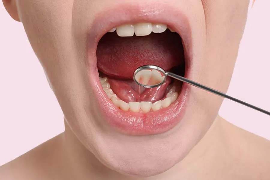 Sharp teeth can also cause oral cancer, says dentist