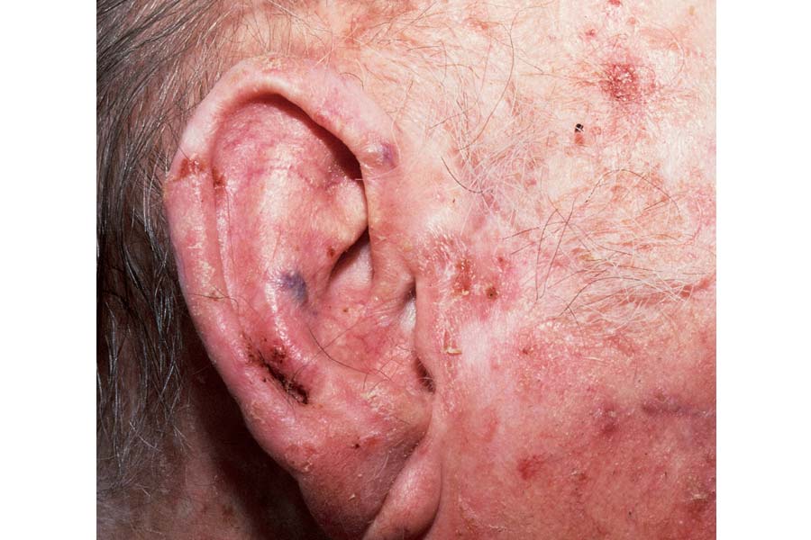 Michael Clarke diagnosed with skin cancer, know the symptoms and causes of the disease