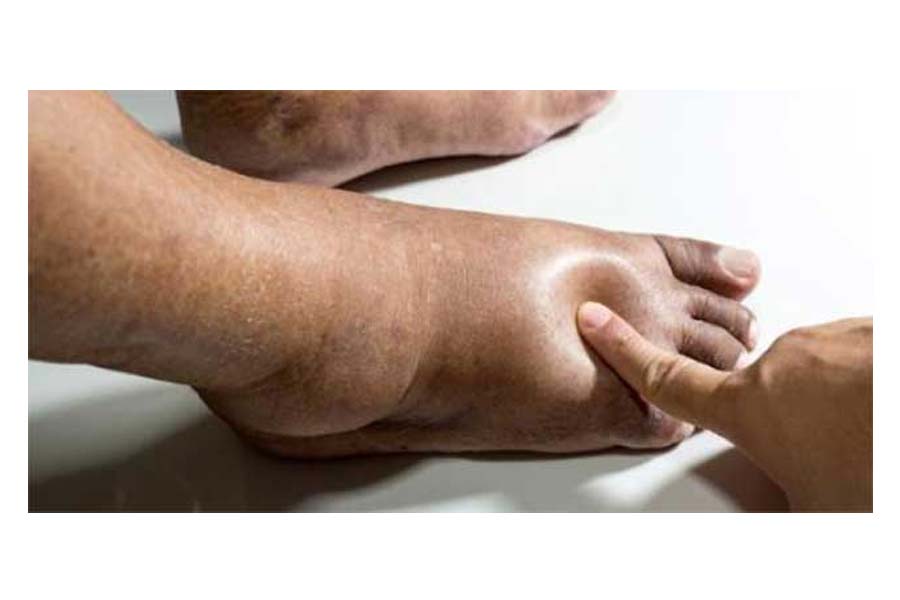 Know the symptoms of kidney problems