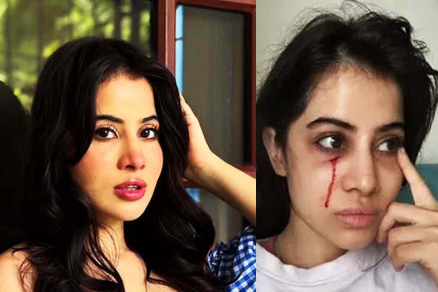 Uorfi Javed Injured After Cat Scratch