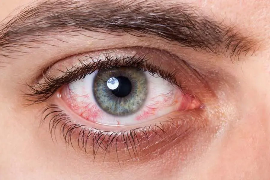 8 Odisha students hospitalised after classmates put Fevikwik in their eyes