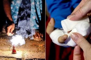 How to give first aid if you get burned while bursting firecrackers during Diwali