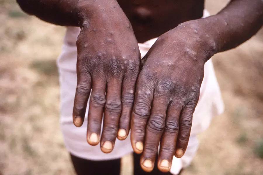 'MPox' strain is spreading in US around the world, doctors are worried about a new scare