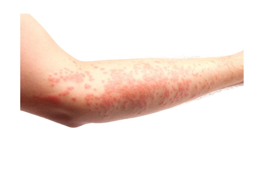Durga Puja Lifestyle: How to prevent skin allergies when wearing jewelry