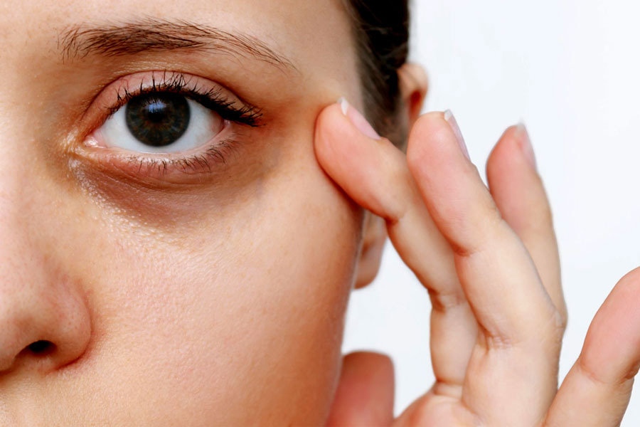 Durga Puja Lifestyle: know how to get rid of dark circle after puja