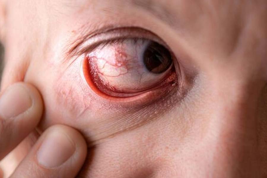What are the possible symptoms and ways to prevent eye stroke
